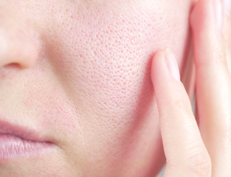 Skin-texture-enlarged-pores-part-womans